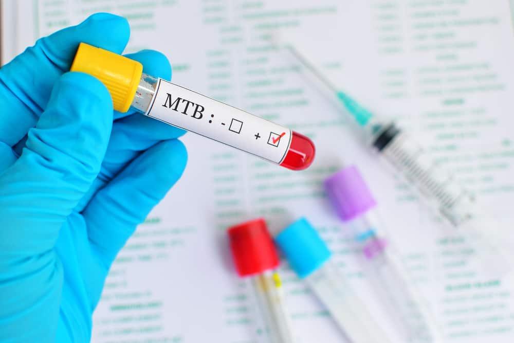 hiv-harus-segera-cek-tb