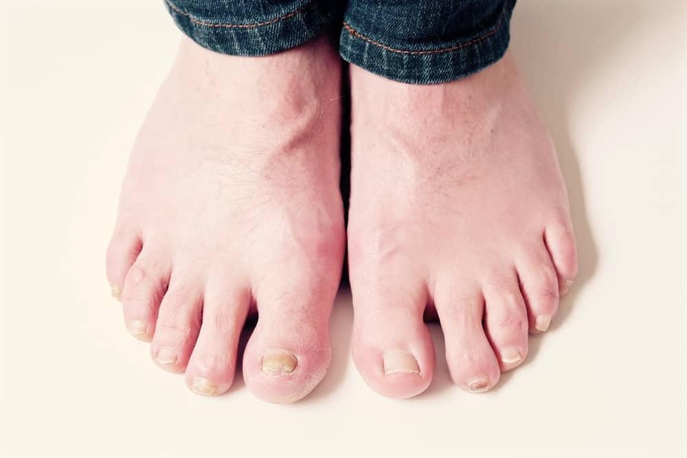 3 Penyebab Kuku Kaki Menebal yang Paling Umum, Plus Tips Mengatasinya