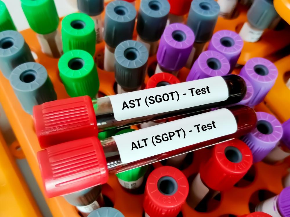 sgot-dan-sgpt-tinggi-apakah-karena-liver