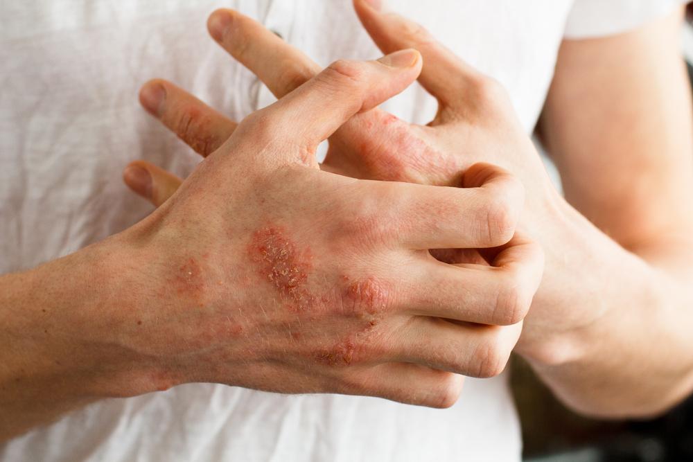 Penyebab Psoriasis dan Faktor-Faktor Risiko yang Perlu Dihindari