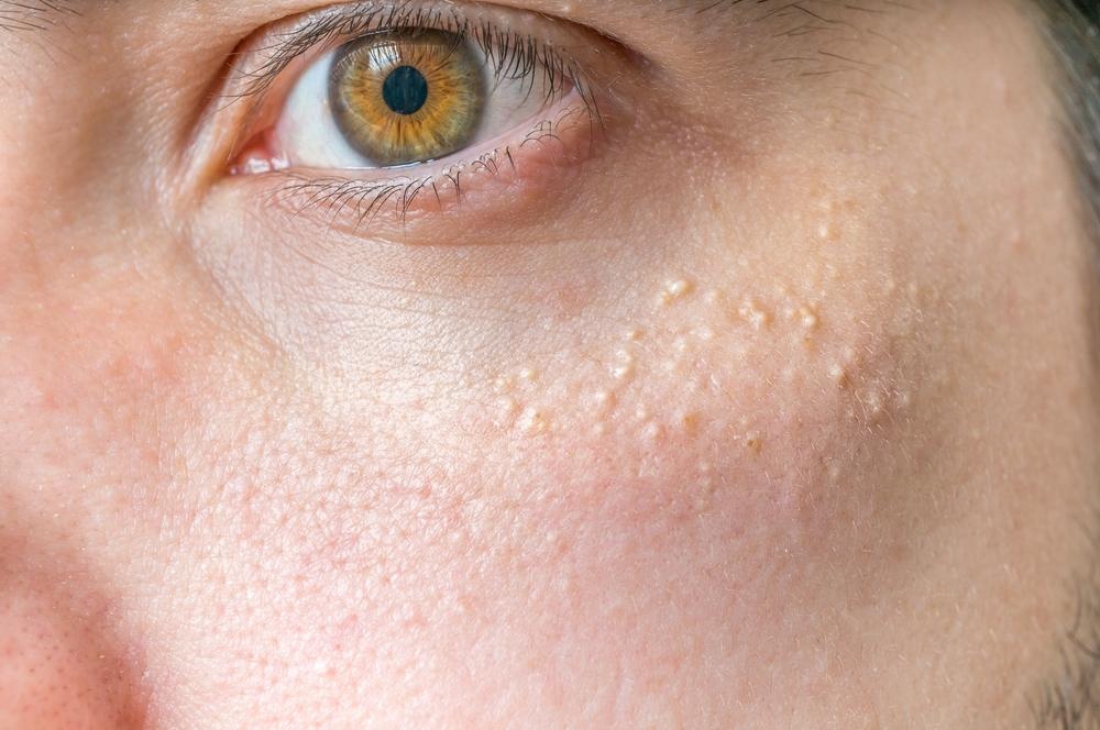 4 Penyebab Munculnya Bintik Putih Atau White Spots di Wajah