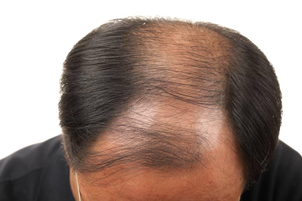 Benarkah Sering Masturbasi Bikin Rambut Rontok?