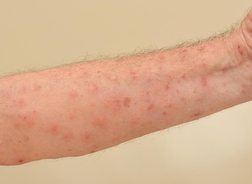 10 Penyebab Munculnya Bintik Merah pada Kulit