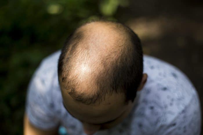 mengobati-rambut-rontok-alopecia-areata
