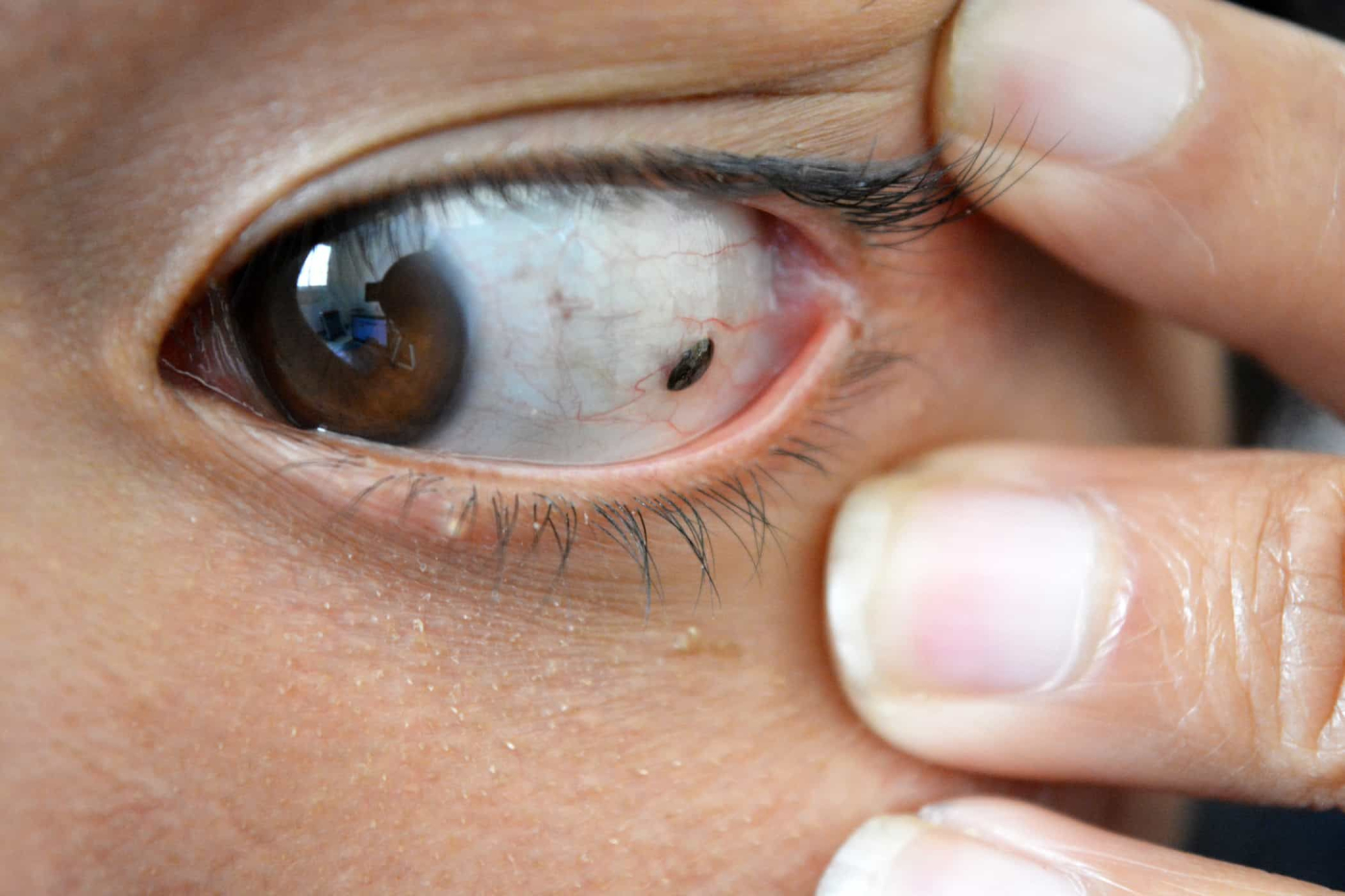 Tak Cuma Menyerang Kulit, Kanker Melanoma Juga Bisa Muncul di Mata