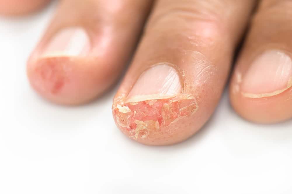 kulit-jari-mengelupas