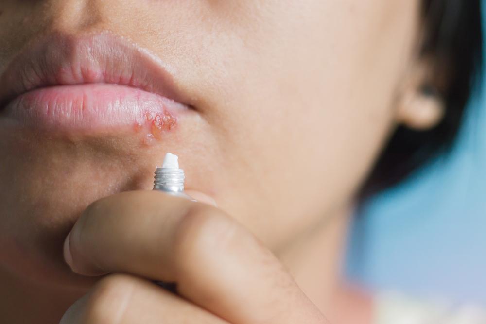cara-mengobati-herpes-obat-herpes