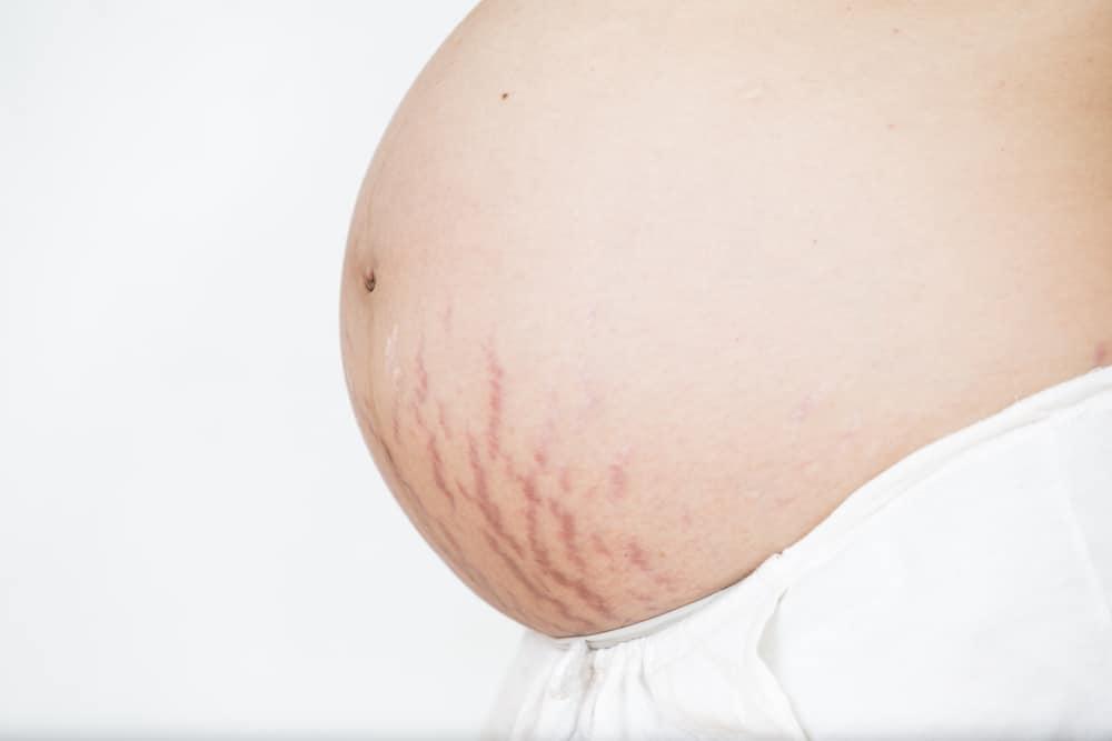 Cara Medis dan Alami untuk Menghilangkan Stretch Mark Setelah Melahirkan