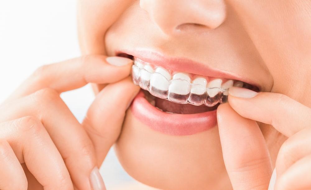 cara-merapikan-gigi-dengan-invisalign