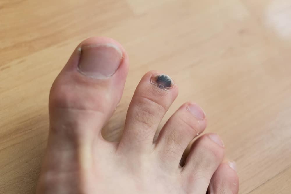 Cara Ampuh Mengobati Darah Beku di Kuku (Hematoma Subungual)
