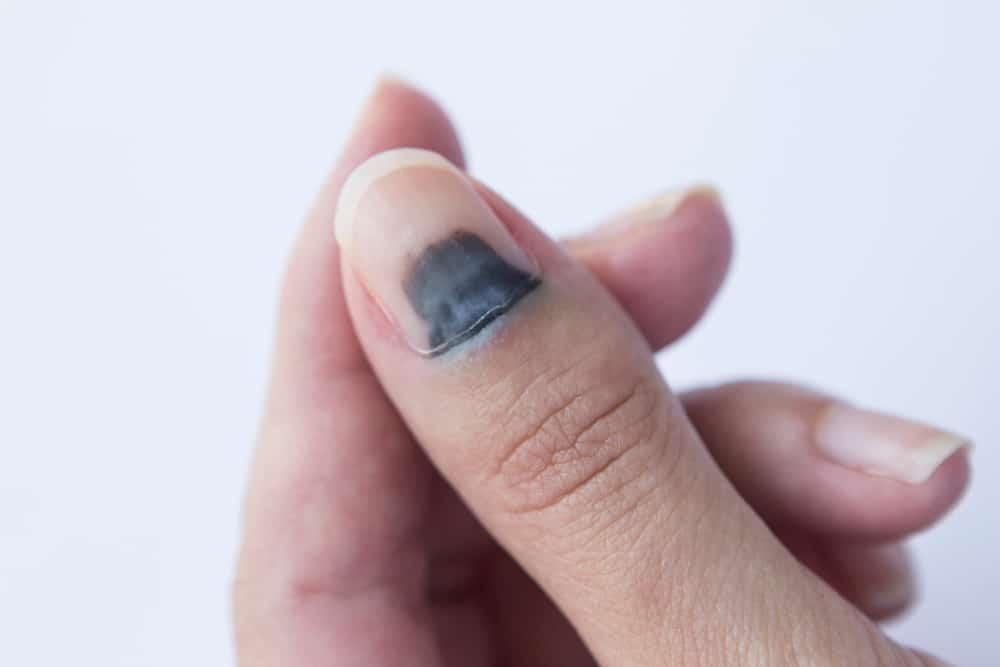 garis-hitam-di-kuku-melanoma-subungual
