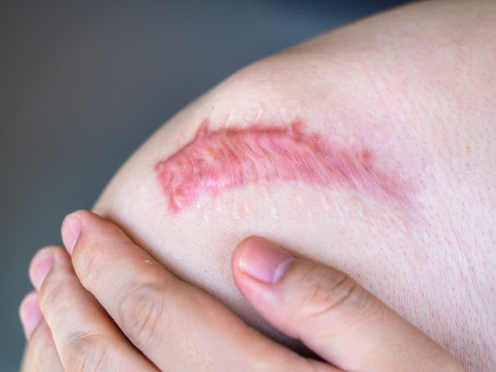 Mendeteksi Ciri-Ciri Keloid sejak Awal Kemunculannya