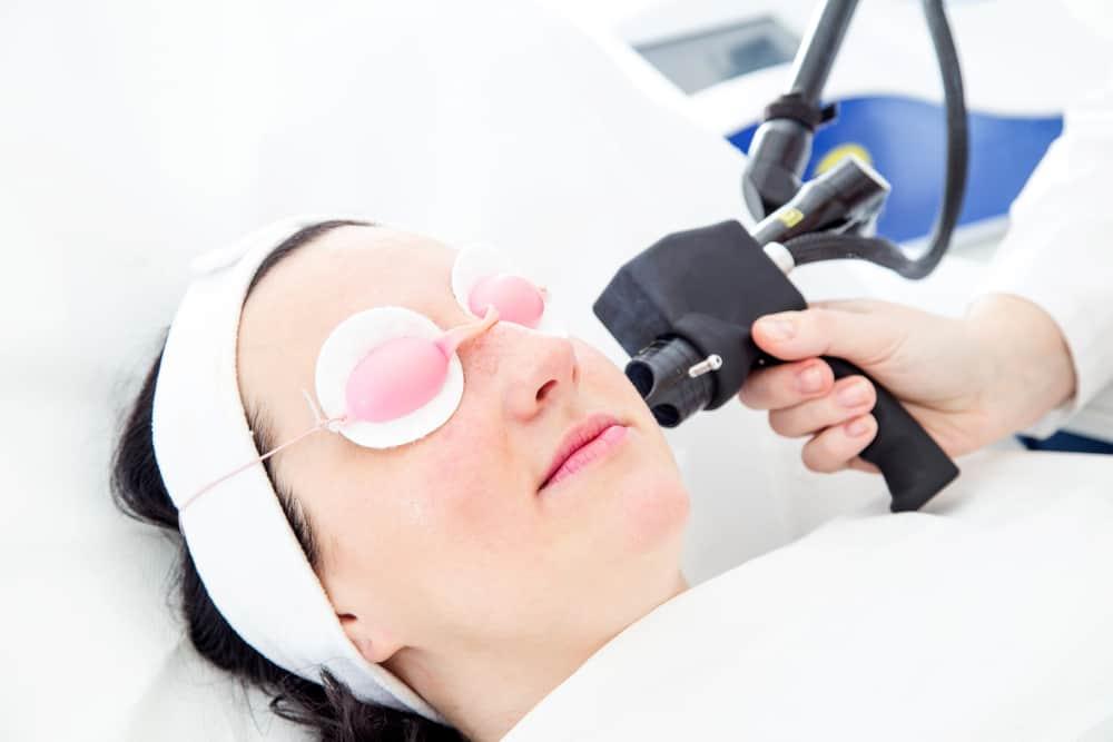 laser-wajah-resurfacing