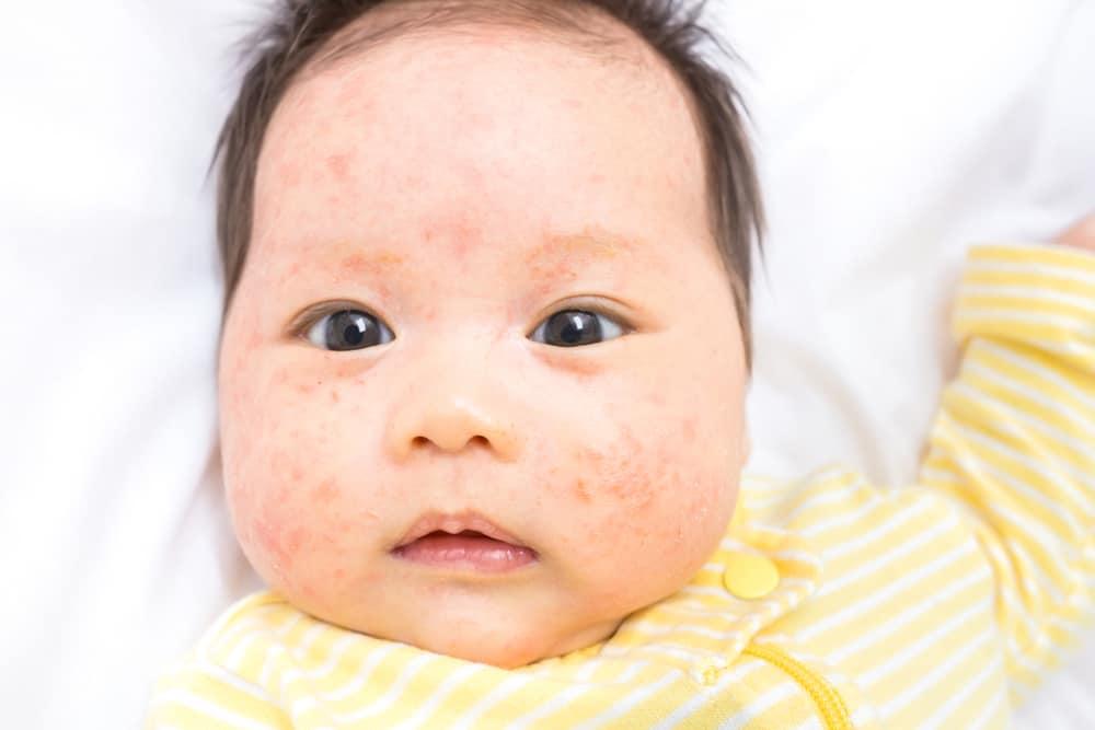 Mirip Dengan Cacar Air, Begini Cara Membedakan Gejala Impetigo Pada Anak