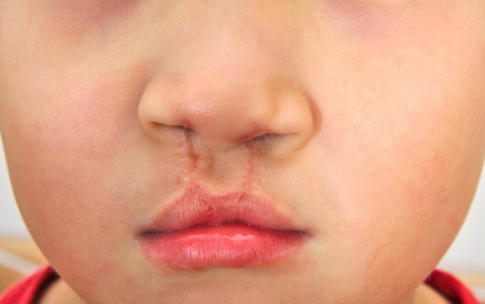 pengertian-bibir-sumbing