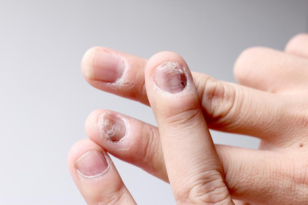Gejala Hampir Mirip, Inilah Beda Psoriasis Kuku dan Jamur Kuku