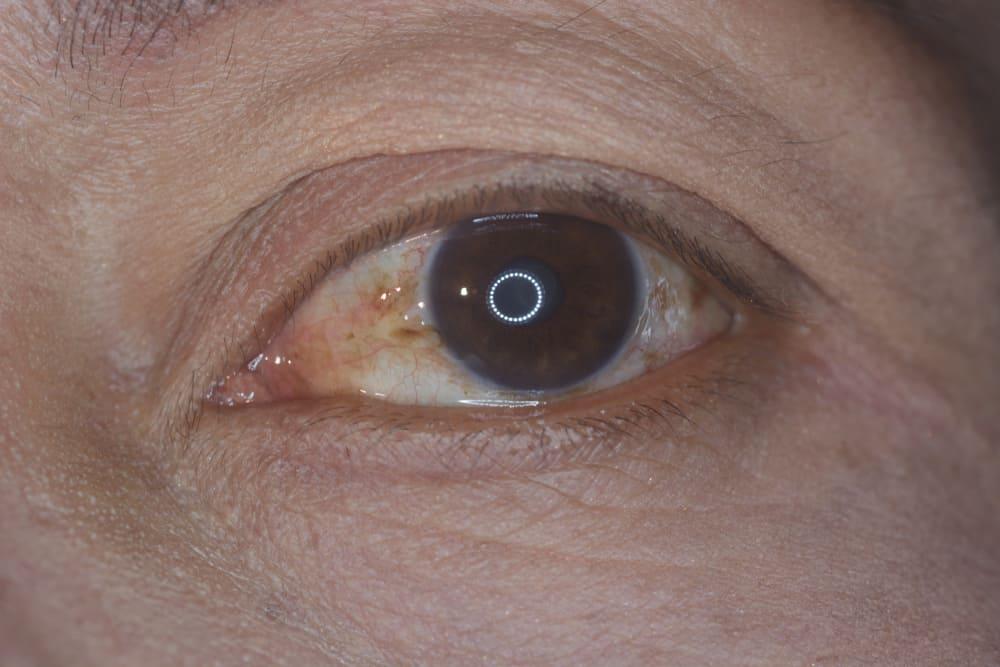 pinguecula
