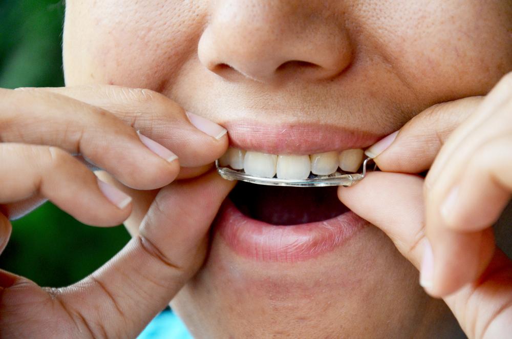 kenapa-pasang-retainer-gigi