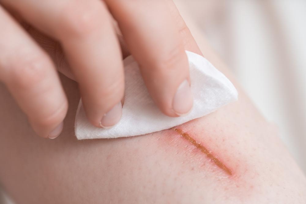Selulitis