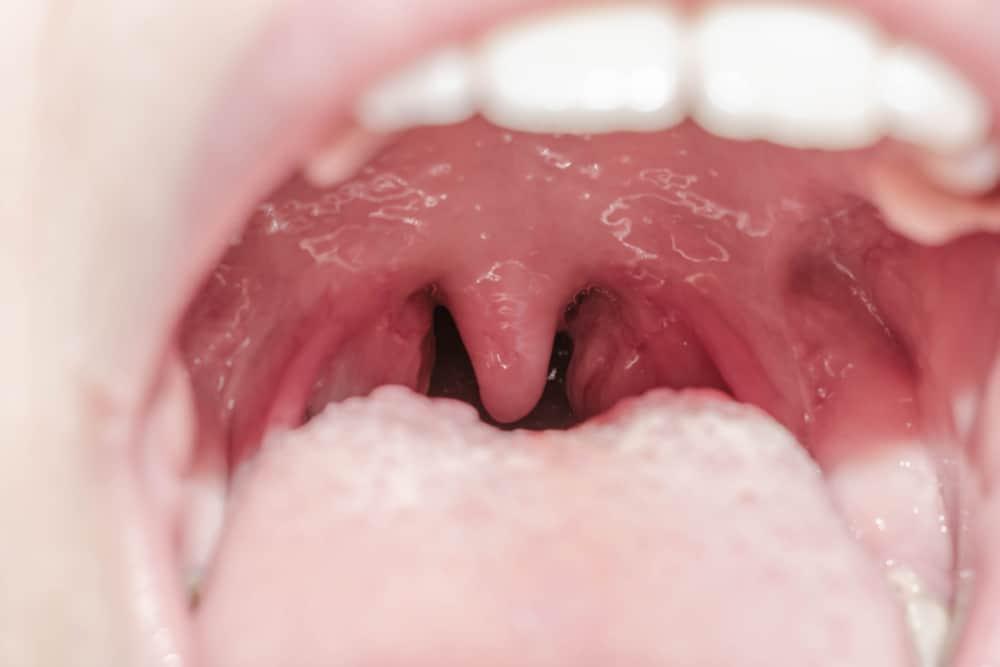 tonsil-adalah-amandel