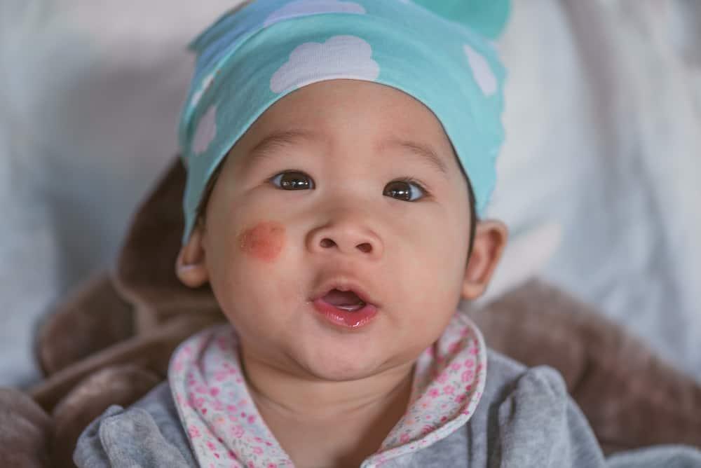 Penyebab Munculnya Ruam Eksim di Pipi Bayi Ternyata Bukan Karena ASI