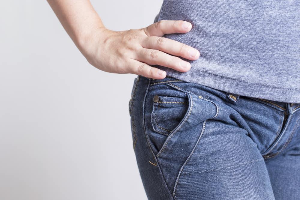 Berbagai Cara yang Efektif Mengatasi Stretch Mark Membandel di Pinggul