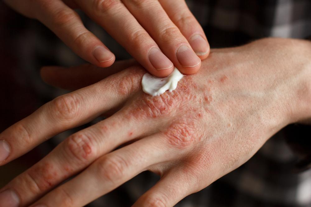 Sederet Bahan Herbal yang Berpotensi Sebagai Obat untuk Psoriasis