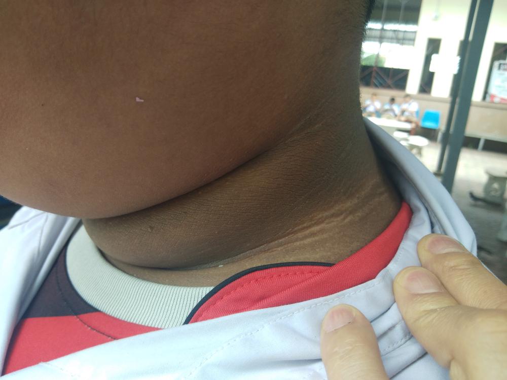 acanthosis-nigricans