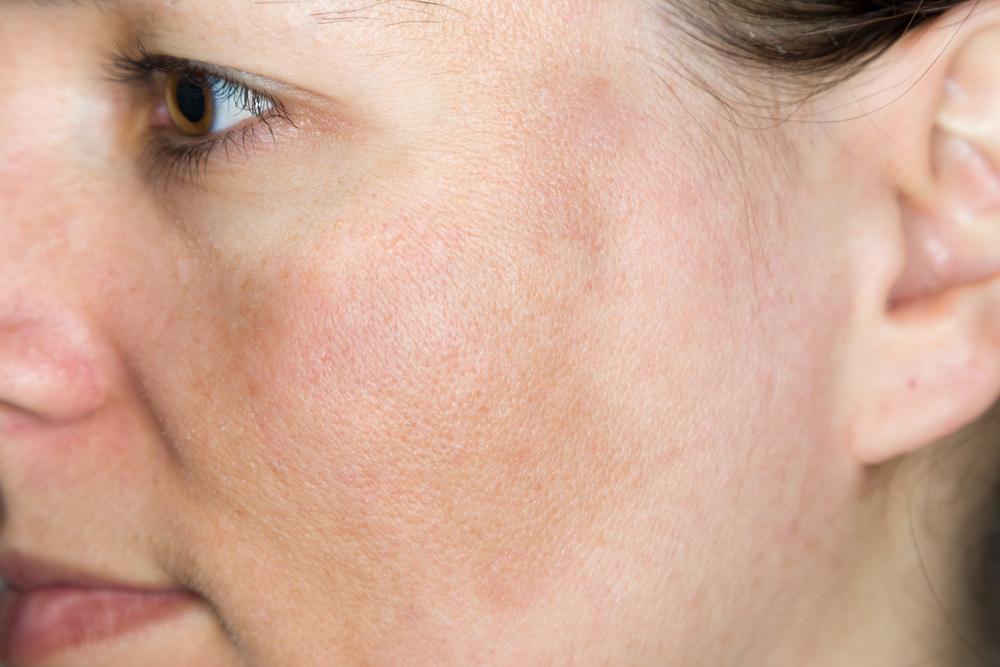 melasma