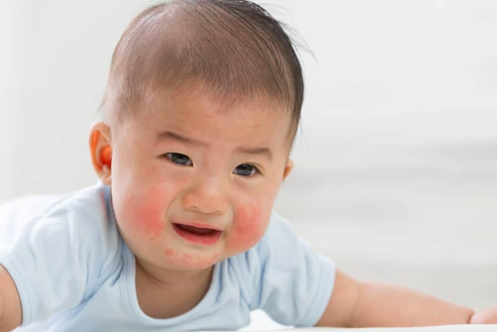 Pahami Serba-serbi Iritasi Kulit pada Bayi, dari Penyebab Hingga Cara Mengatasinya