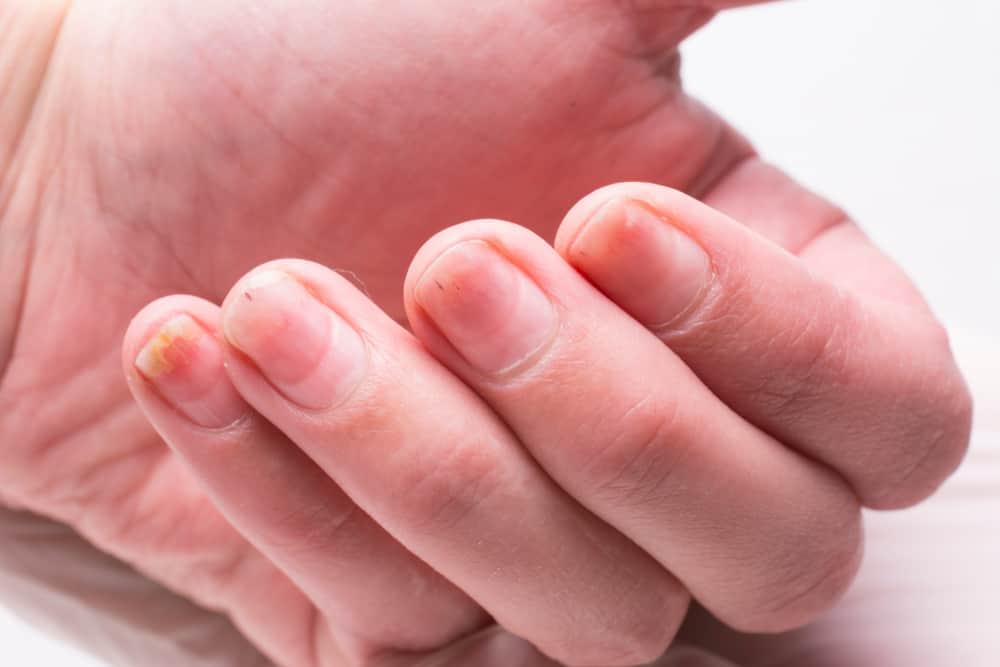 Lekukan pada Kuku, Ini Bisa Jadi Tanda Psoriasis Kuku