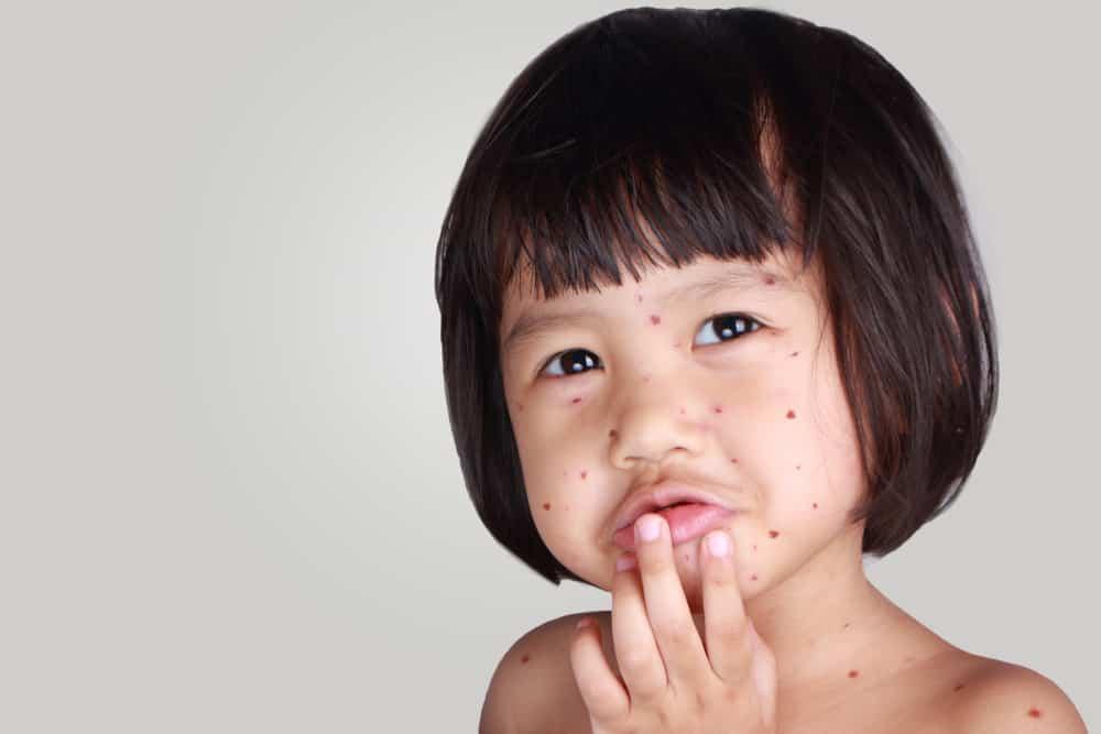Cacar (Smallpox)