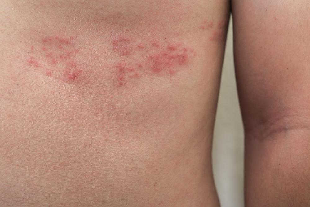 Herpes Zoster (Cacar Api)