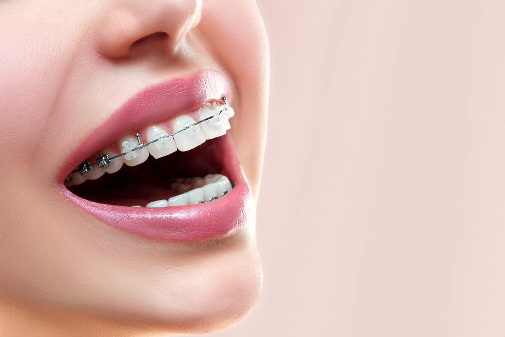 Merapikan Gigi dengan Behel dan Invisalign, Apa Perbedaanya?