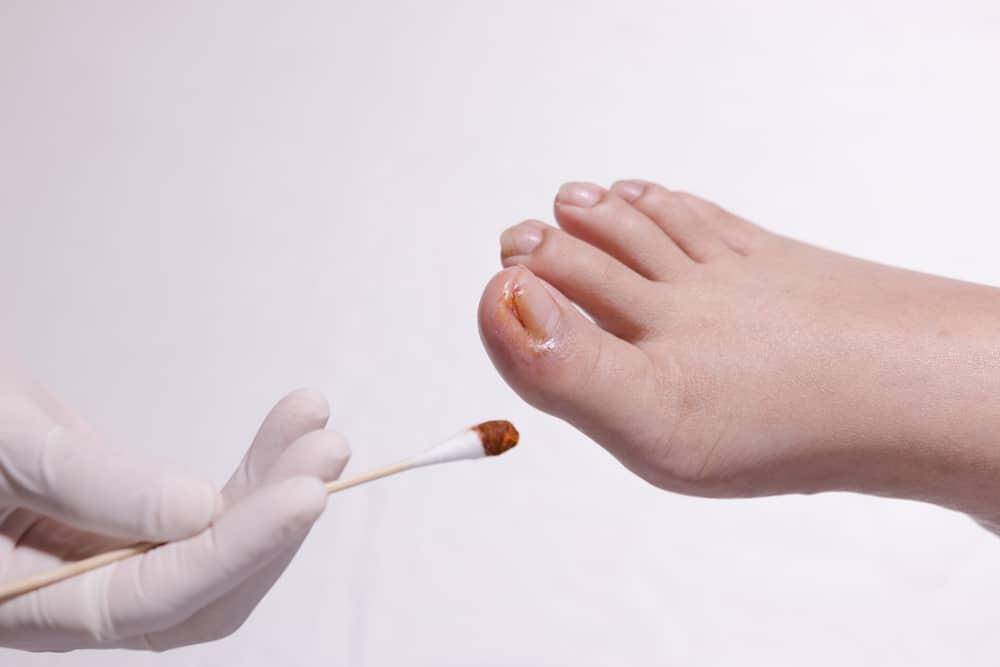 3 Jenis Masalah yang Paling Sering Terjadi Pada Kuku Kaki (Plus Cara Mengatasinya)