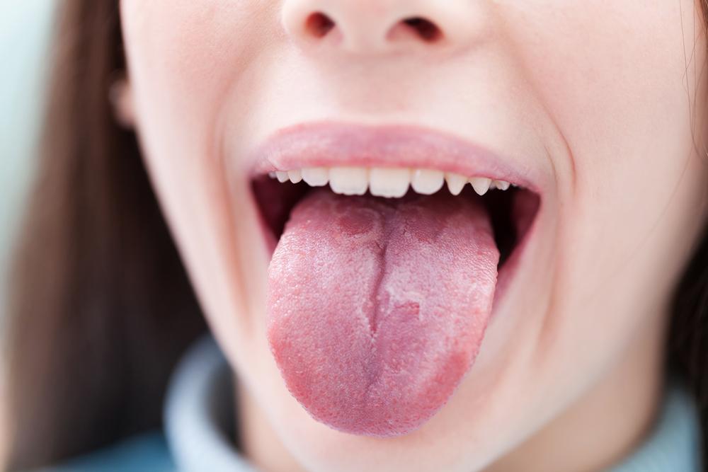 Meski Tampak Sama, Ini Beda Oral Trush, Lidah Peta, dan Oral Hairy Leukoplakia (OHL)