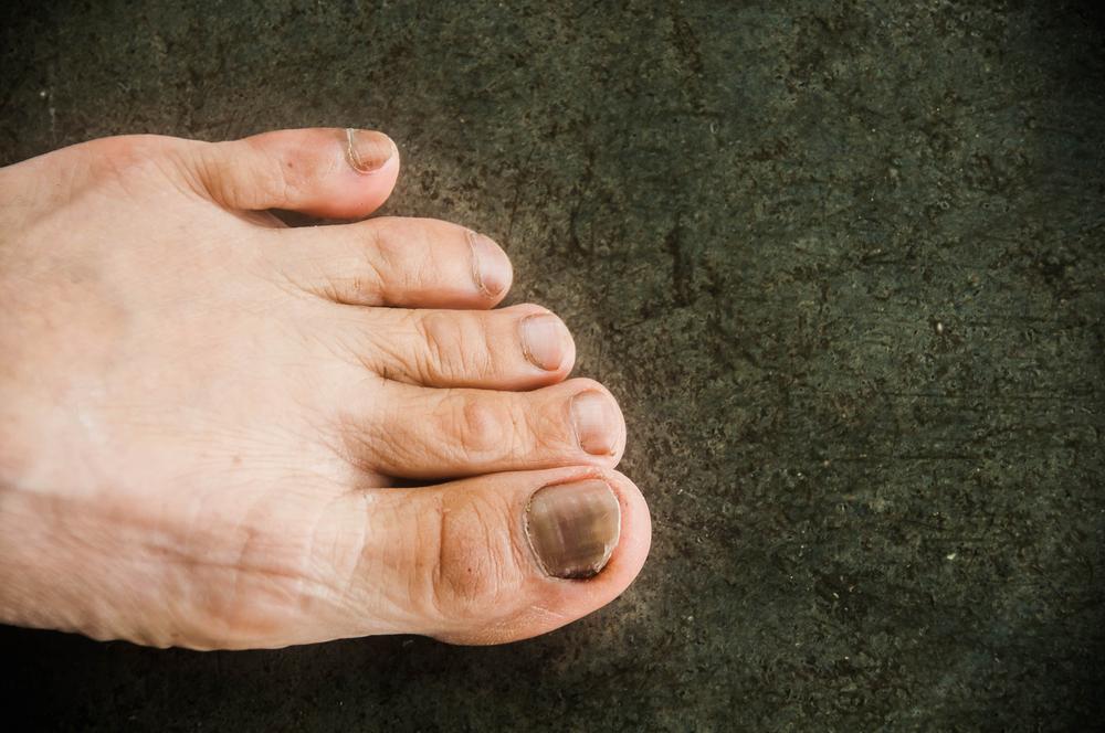 3 Penyebab Kuku Kaki Anda Jadi Menghitam dan Menebal