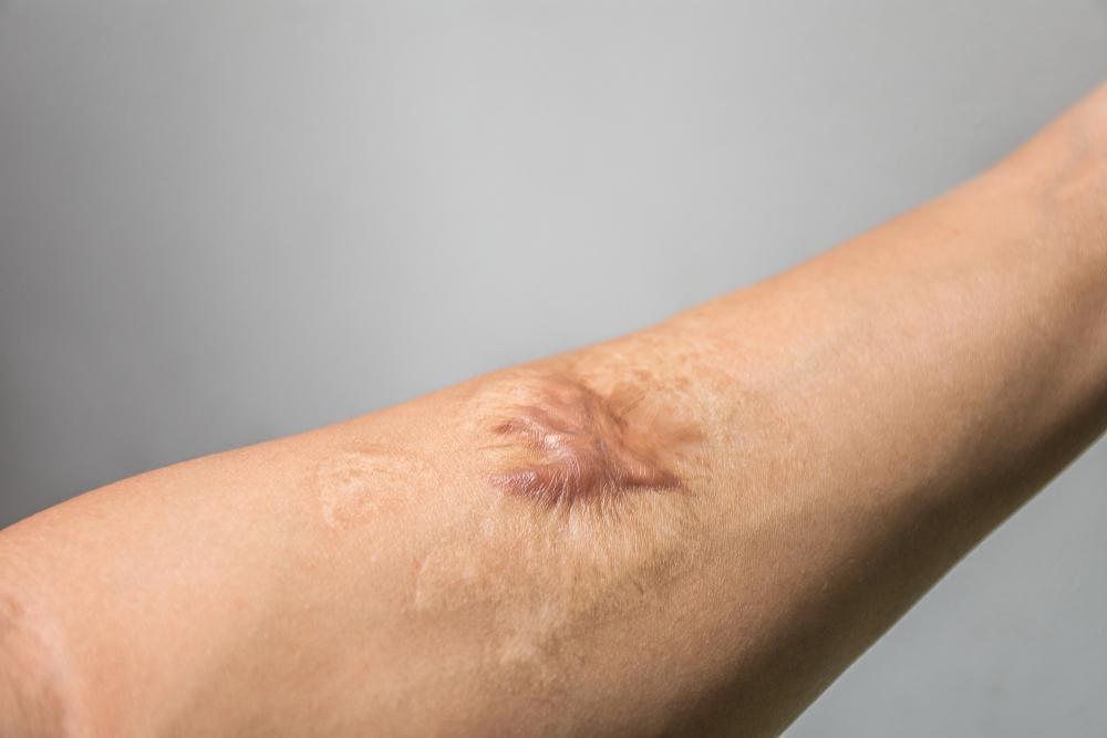 Bekas Luka Menonjol di Kulit, Bisa Jadi Keloid Atau Skar Hipertrofi