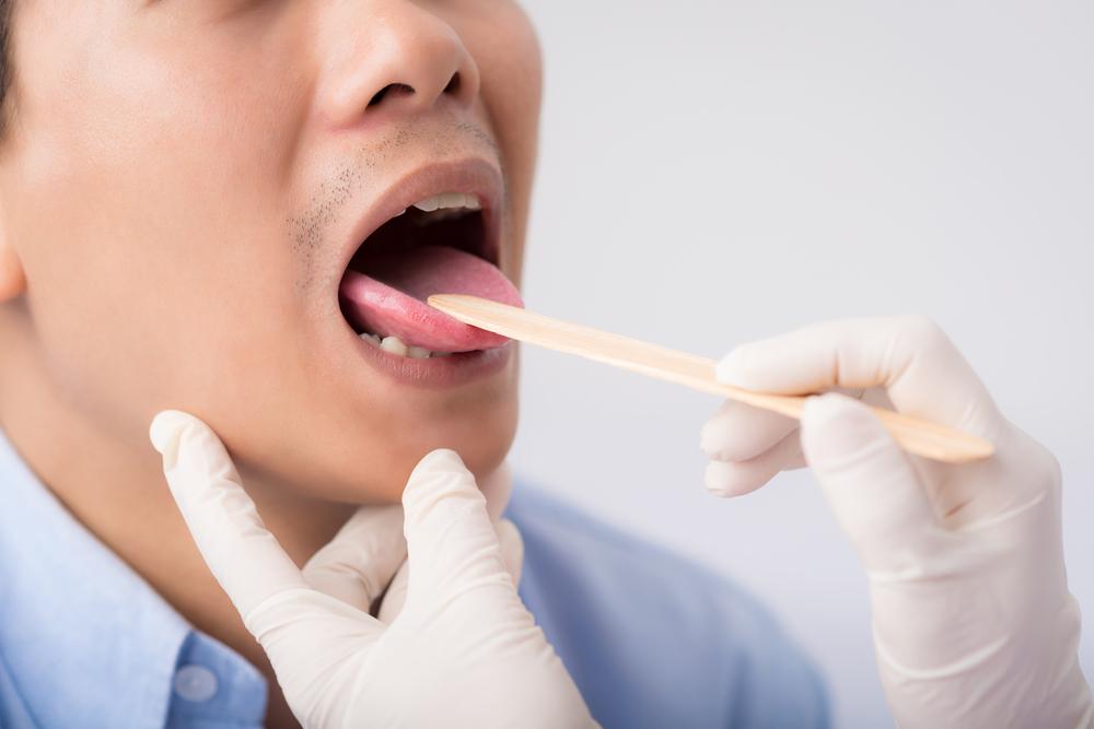 Timbul Bercak Putih Menonjol Dalam Mulut? Mungkin Anda Mengalami Leukoplakia