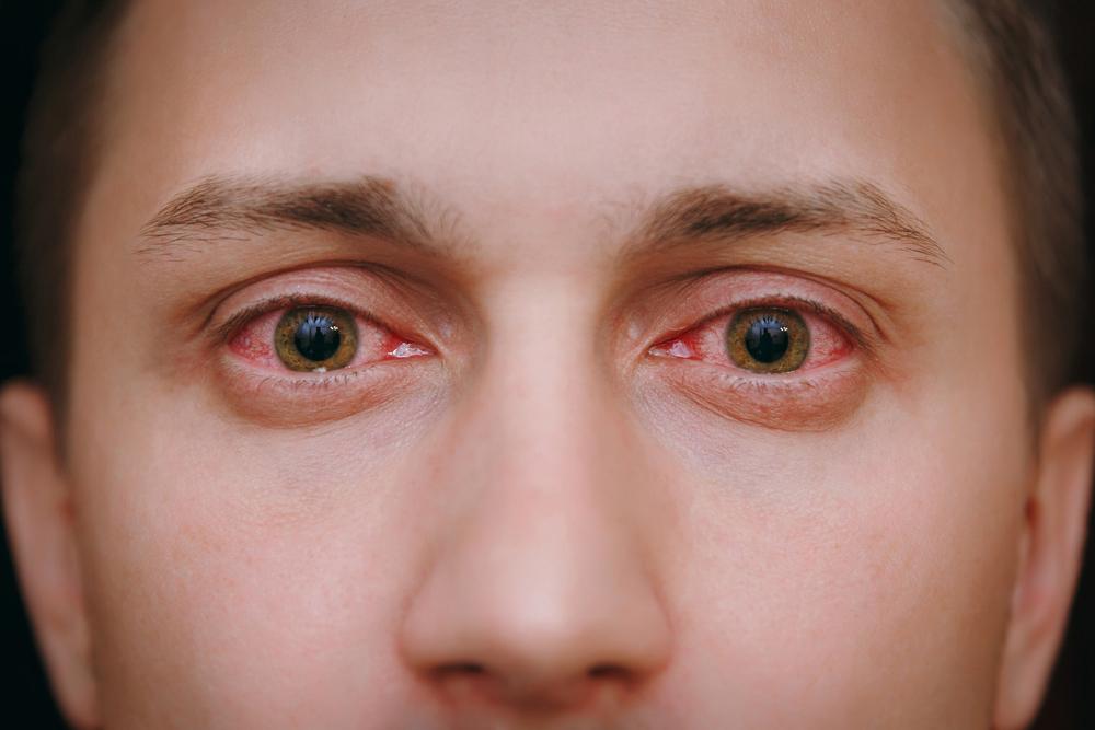 7 Mitos Mata Merah Akibat Konjungtivitis yang Perlu Diluruskan