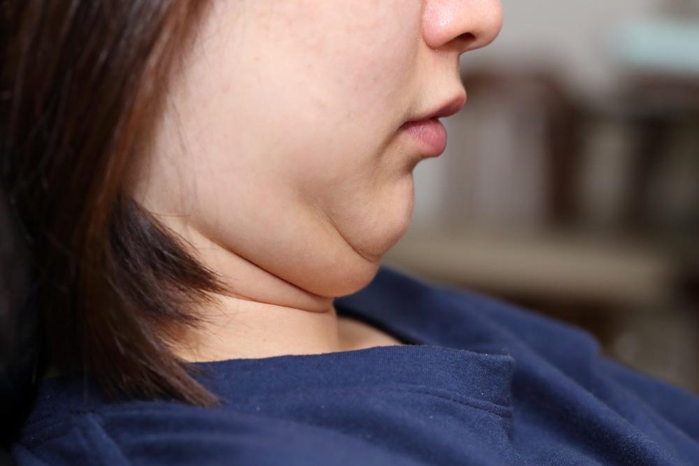 cara-menghilangkan-double-chin