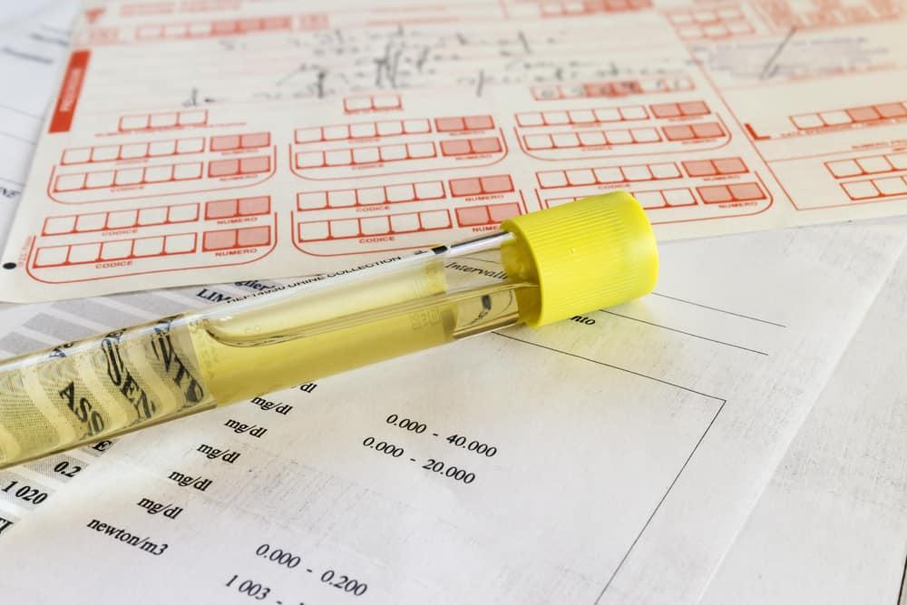 leukosit-dalam-urine