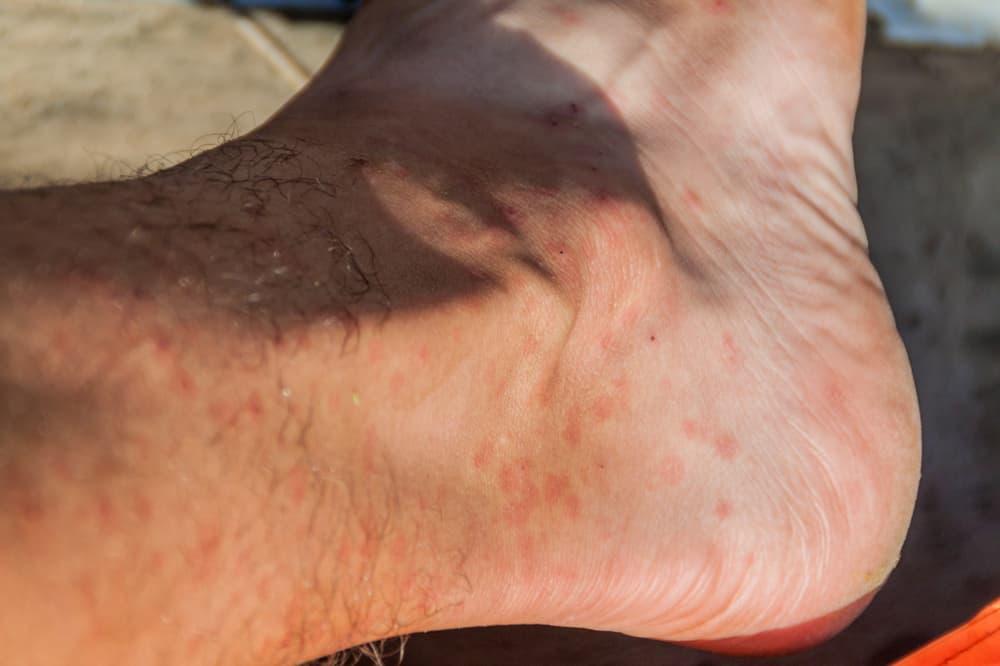 penyebab-leishmaniasis-dan-pengobatannya