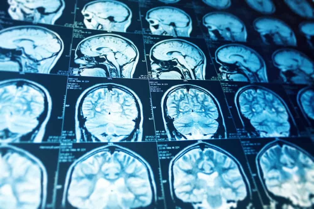 Berbagai Pilihan Obat dan Tindakan Pengobatan untuk Mengatasi Stroke