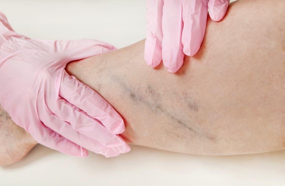 gejala-deep-vein-thrombosis