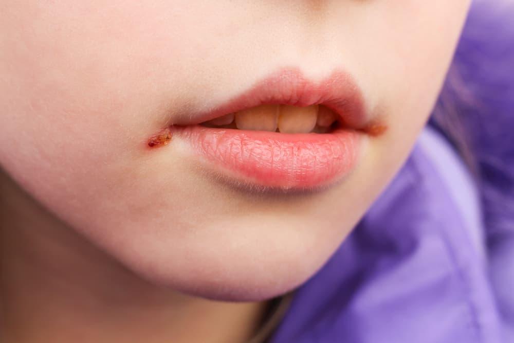 Herpes Juga Bisa Menyerang Si Kecil, Ini Cara Mencegahnya