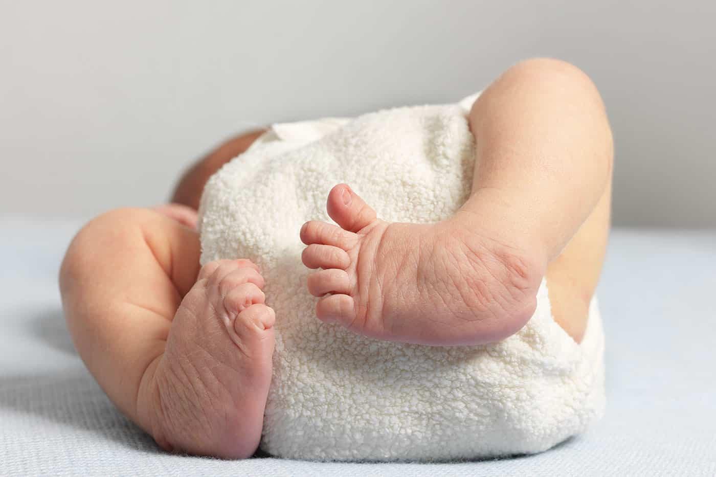Clubfoot