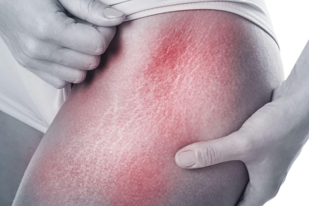 menghilangkan-stretch-mark-di-paha