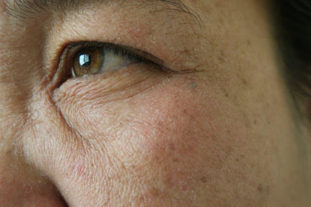 menghilangkan-freckles-di-mata