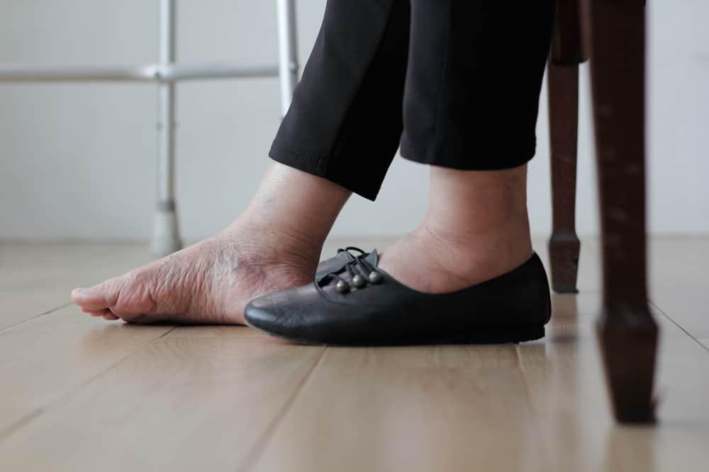 Mengenal Sindrom Angioedema, Pembengkakan Pada Kaki Hingga Organ Intim